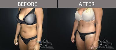Abdominoplasty Before & After Gallery - Patient 90705031 - Image 2