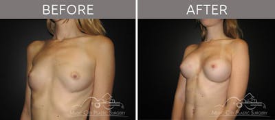 Breast Augmentation Before & After Gallery - Patient 90705034 - Image 2