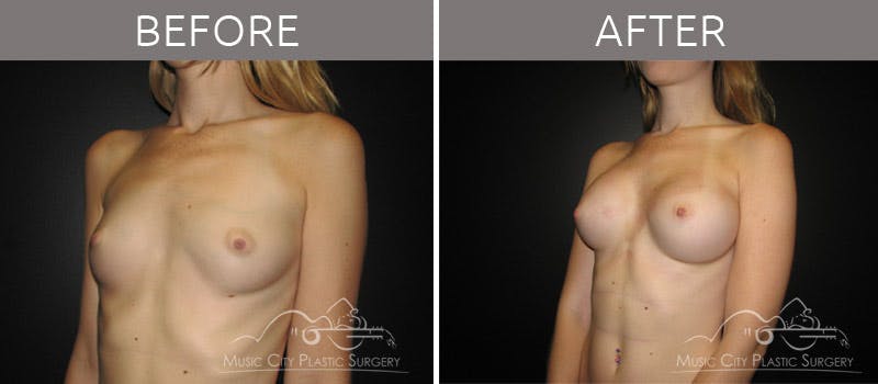 Breast Augmentation Before & After Gallery - Patient 90705034 - Image 2
