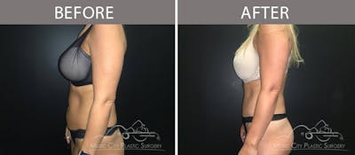 Abdominoplasty Before & After Gallery - Patient 90705031 - Image 3