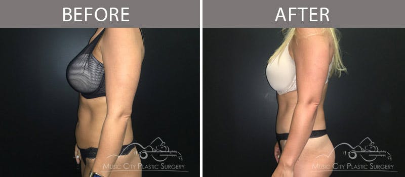 Abdominoplasty Before & After Gallery - Patient 90705031 - Image 3