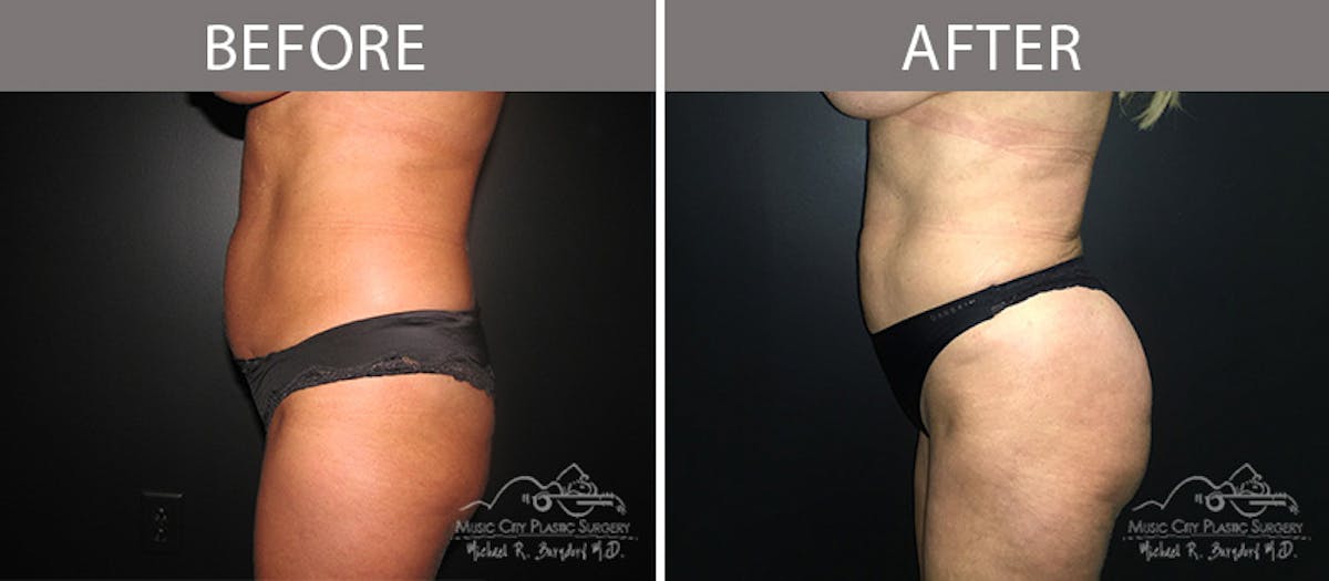 Liposuction Before & After Gallery - Patient 90705033 - Image 1