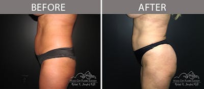 Liposuction Before & After Gallery - Patient 90705033 - Image 1