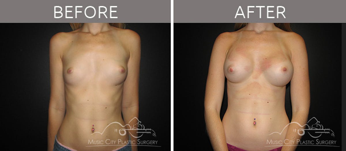 Breast Augmentation Before & After Gallery - Patient 90705034 - Image 1