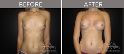 Breast Augmentation Before & After Gallery - Patient 90705034 - Image 1
