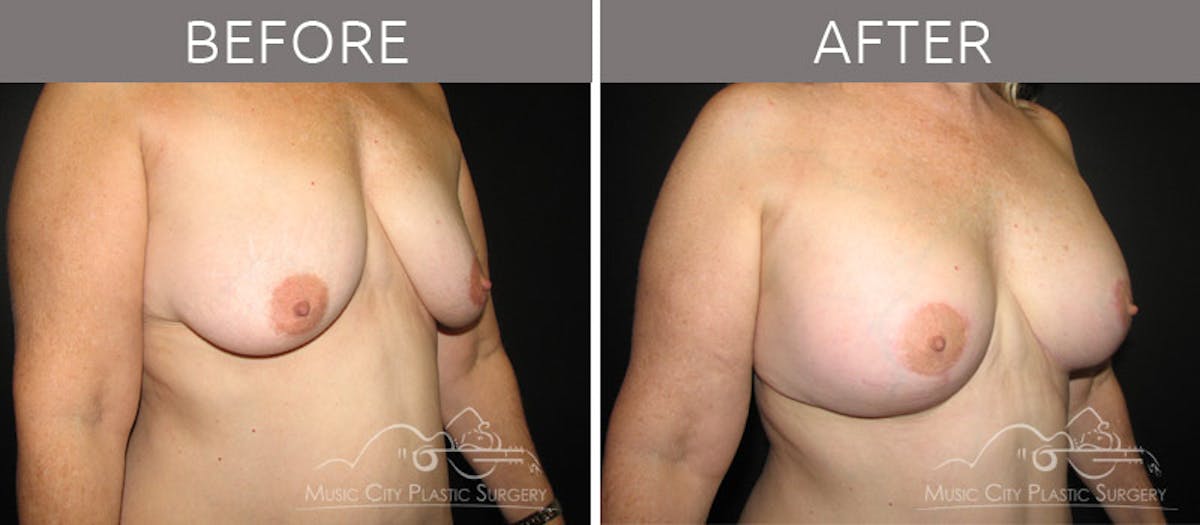 Mommy Makeover Before & After Gallery - Patient 90705032 - Image 2