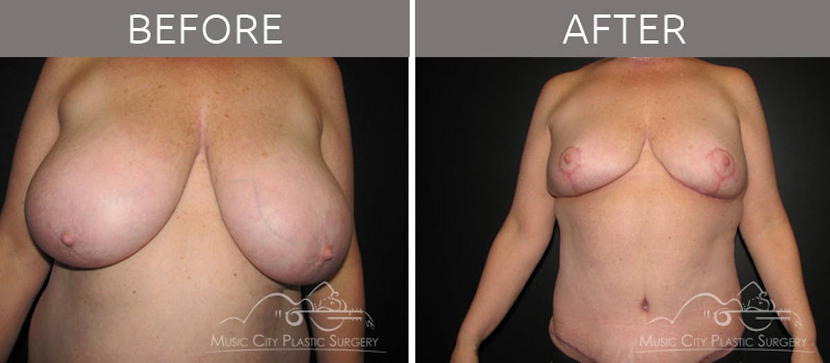 Breast Reduction with Lift Before & After Gallery - Patient 132099798 - Image 1
