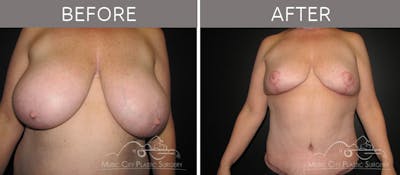 Breast Reduction with Lift Before & After Gallery - Patient 132099798 - Image 3
