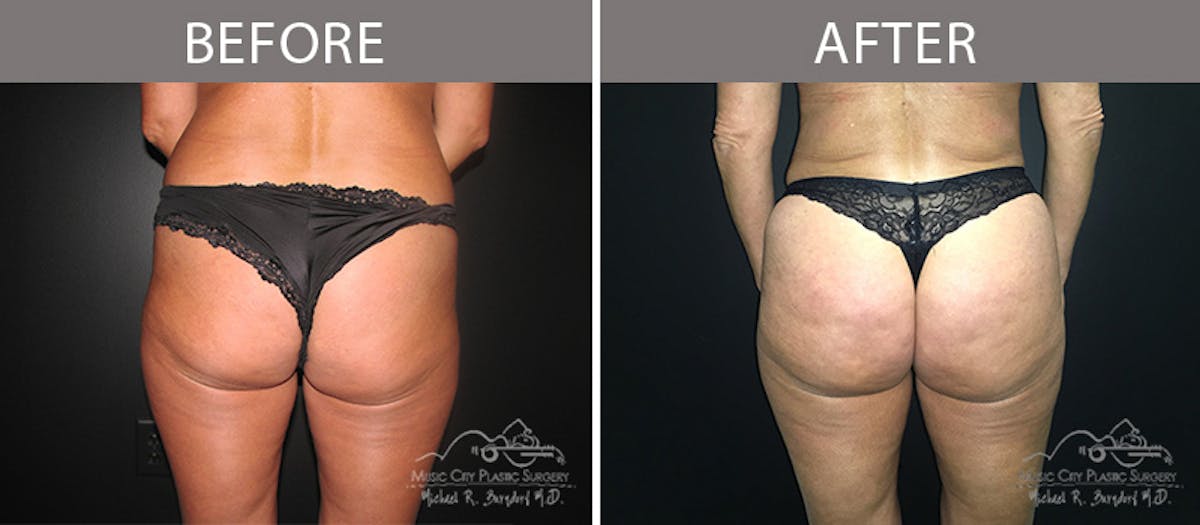 Liposuction Before & After Gallery - Patient 90705033 - Image 2