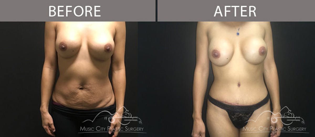 Abdominoplasty Before & After Gallery - Patient 90705036 - Image 1