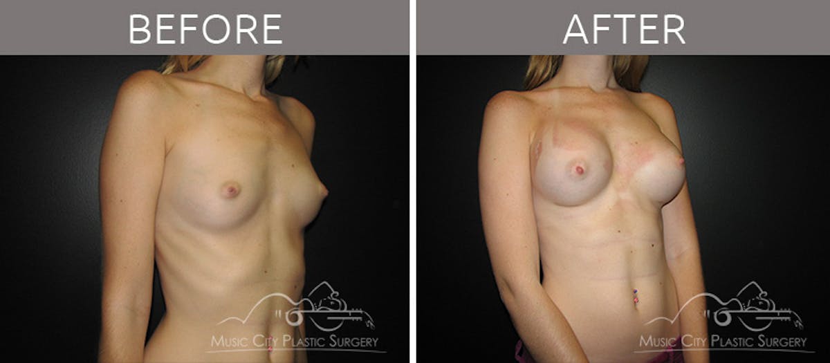 Breast Augmentation Before & After Gallery - Patient 90705034 - Image 4
