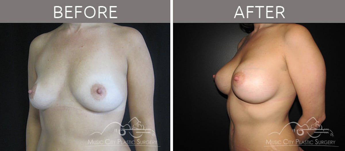 Mommy Makeover Before & After Gallery - Patient 90705049 - Image 2