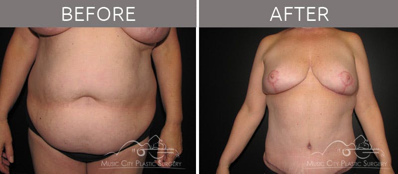 Breast Reduction with Lift Before & After Gallery - Patient 132099798 - Image 4