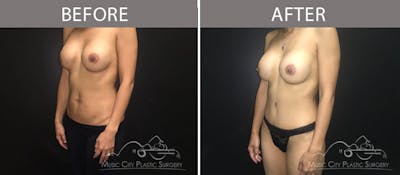Abdominoplasty Before & After Gallery - Patient 90705036 - Image 2