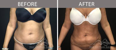 Liposuction Before & After Gallery - Patient 90705040 - Image 1