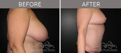 Breast Reduction with Lift Before & After Gallery - Patient 132099798 - Image 3