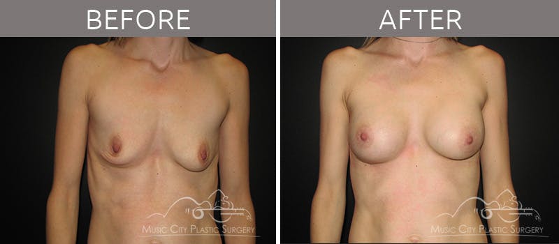 Breast Augmentation Before & After Gallery - Patient 90705041 - Image 1