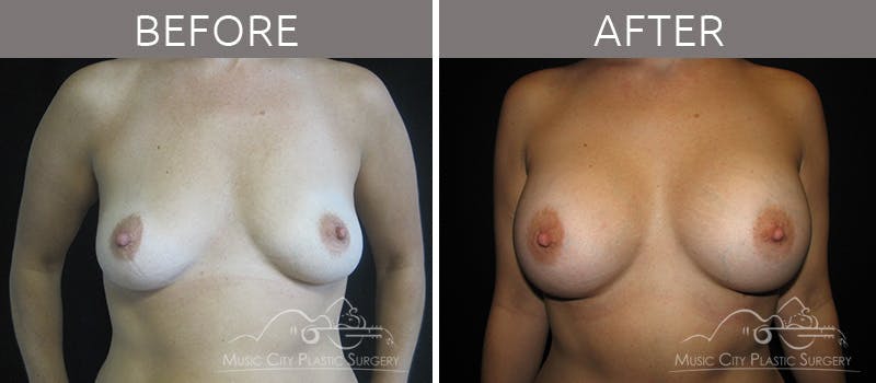 Mommy Makeover Before & After Gallery - Patient 90705049 - Image 2