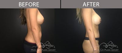 Abdominoplasty Before & After Gallery - Patient 90705036 - Image 3