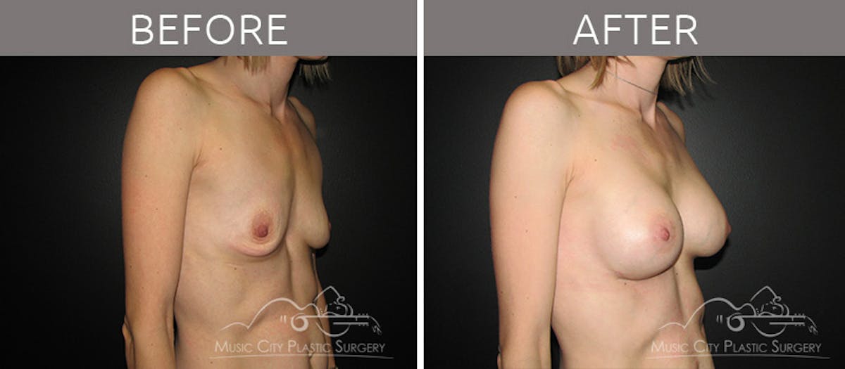 Breast Augmentation Before & After Gallery - Patient 90705041 - Image 2