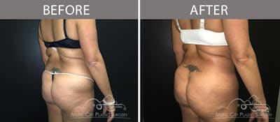 Liposuction Before & After Gallery - Patient 90705040 - Image 2