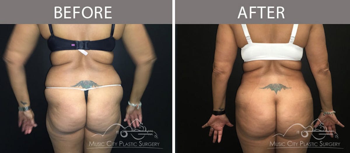 Liposuction Before & After Gallery - Patient 90705040 - Image 3