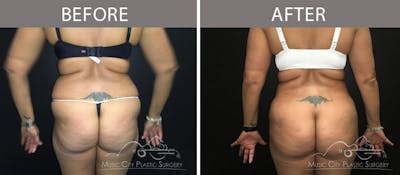 Liposuction Before & After Gallery - Patient 90705040 - Image 3