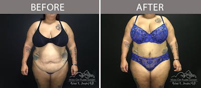 Abdominoplasty Before & After Gallery - Patient 90705048 - Image 1