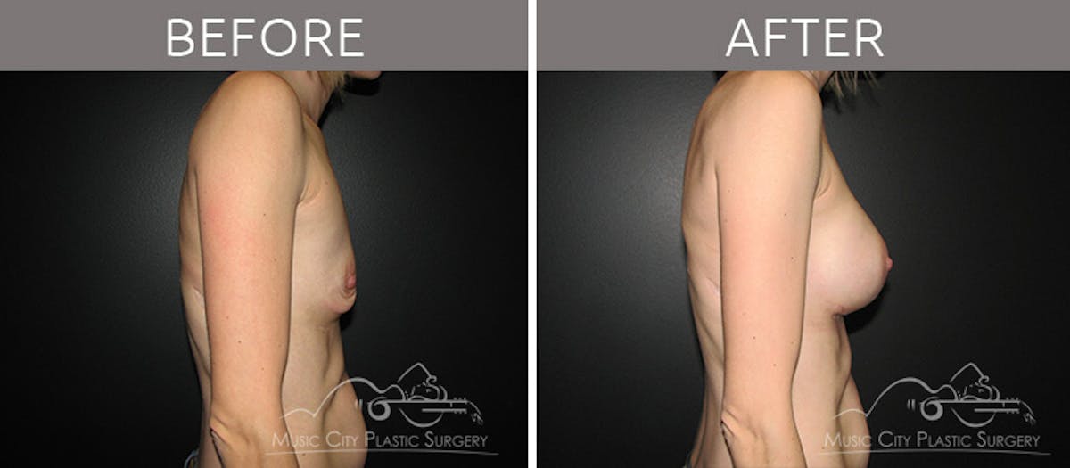 Breast Augmentation Before & After Gallery - Patient 90705041 - Image 3