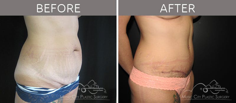 Mommy Makeover Before & After Gallery - Patient 90705049 - Image 4