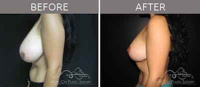 Breast Reduction with Lift Before & After Gallery - Patient 132099797 - Image 3