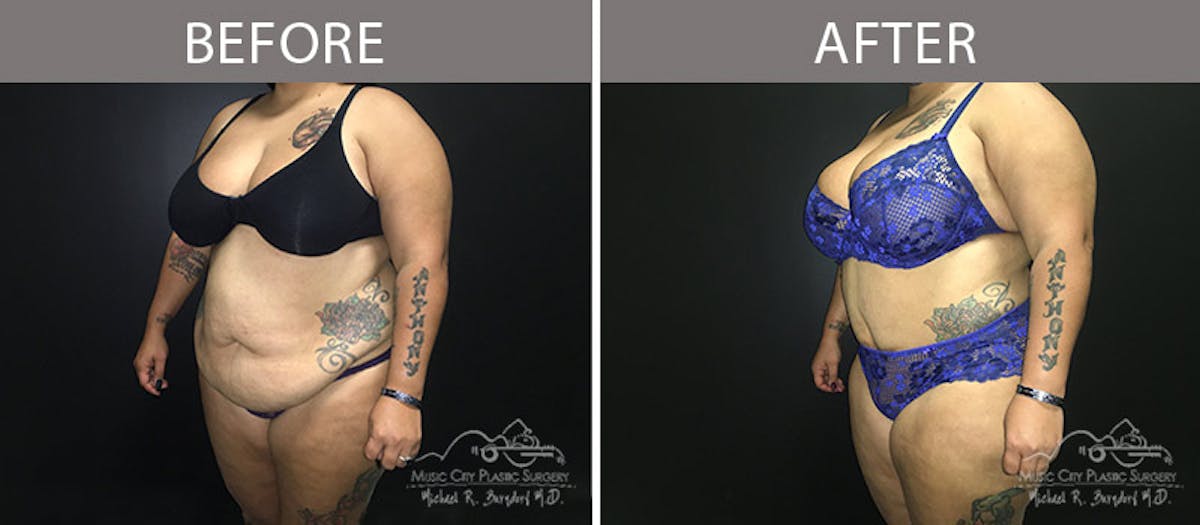 Abdominoplasty Before & After Gallery - Patient 90705048 - Image 2