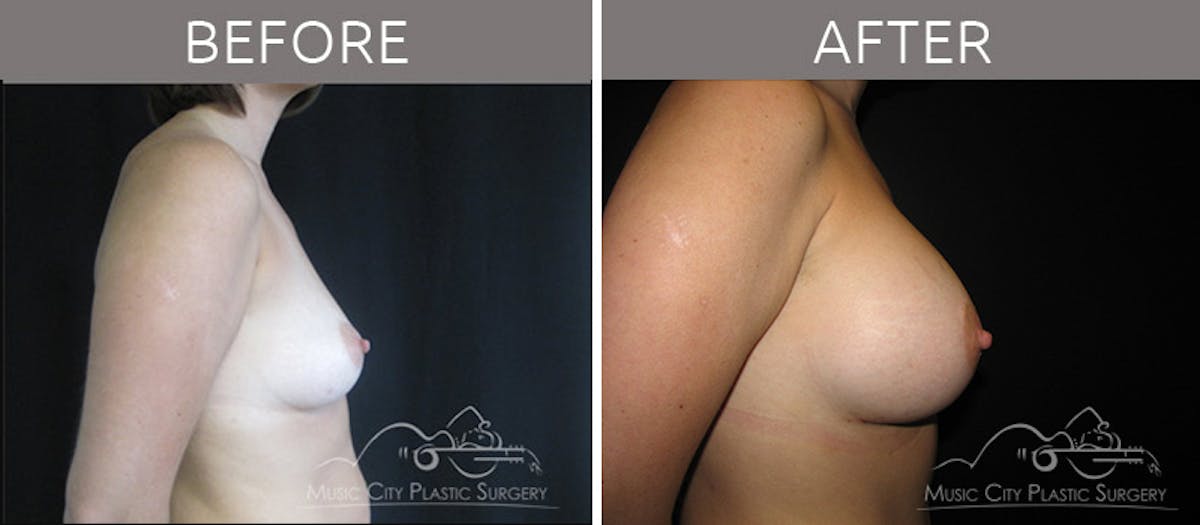 Mommy Makeover Before & After Gallery - Patient 90705049 - Image 3