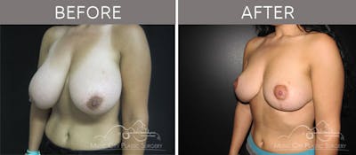 Breast Reduction with Lift Before & After Gallery - Patient 132099797 - Image 2