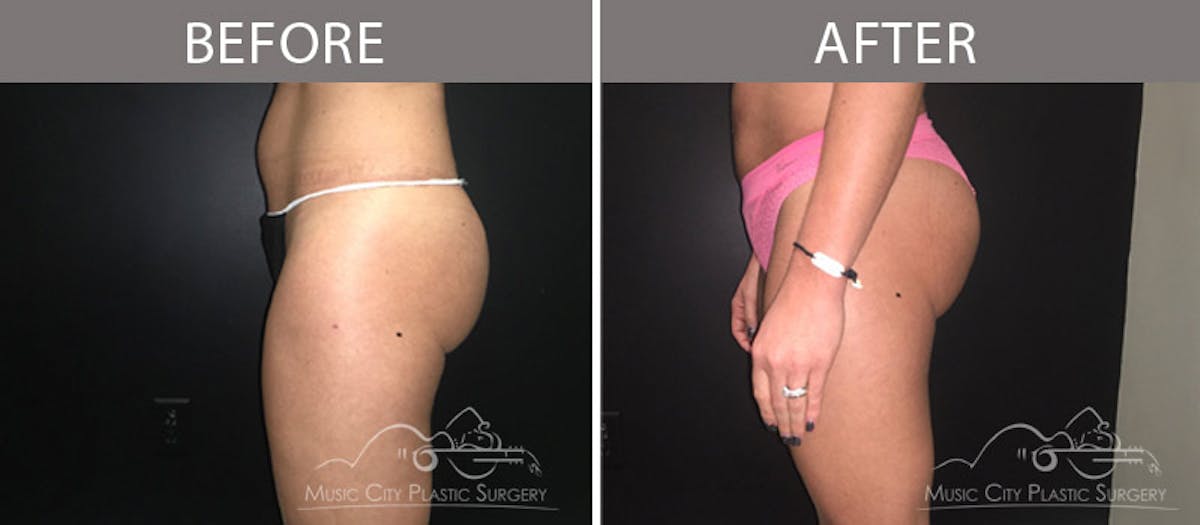 Liposuction Before & After Gallery - Patient 90705051 - Image 2