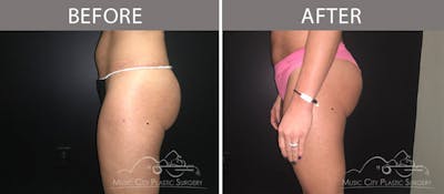 Liposuction Before & After Gallery - Patient 90705051 - Image 1