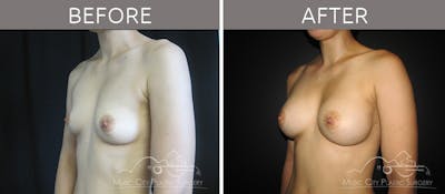 Breast Augmentation Before & After Gallery - Patient 90705054 - Image 2