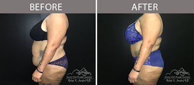 Abdominoplasty Before & After Gallery - Patient 90705048 - Image 3
