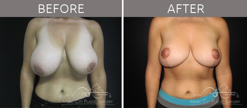 Breast Reduction with Lift Before & After Gallery - Patient 132099797 - Image 1