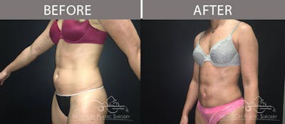 Liposuction Before & After Gallery - Patient 90705051 - Image 1