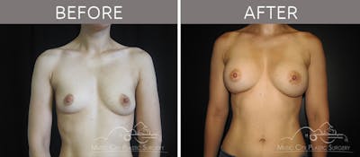 Breast Augmentation Before & After Gallery - Patient 90705054 - Image 1