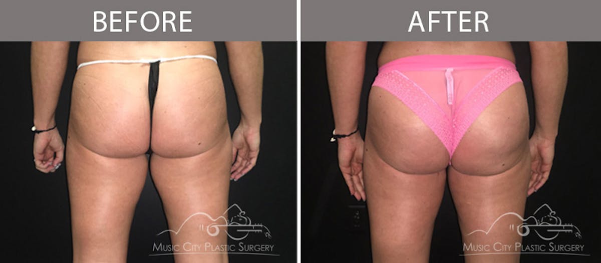 Liposuction Before & After Gallery - Patient 90705051 - Image 3