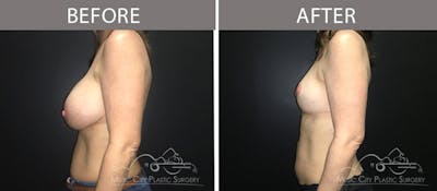 Capsulectomy Before & After Gallery - Patient 90705062 - Image 3