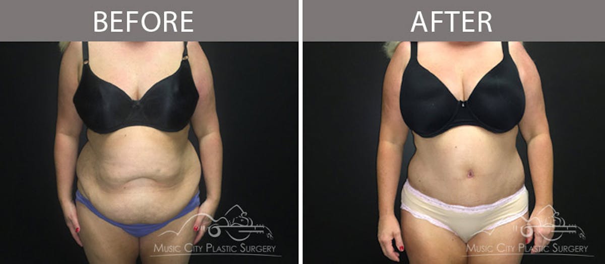 Abdominoplasty Before & After Gallery - Patient 90705063 - Image 1