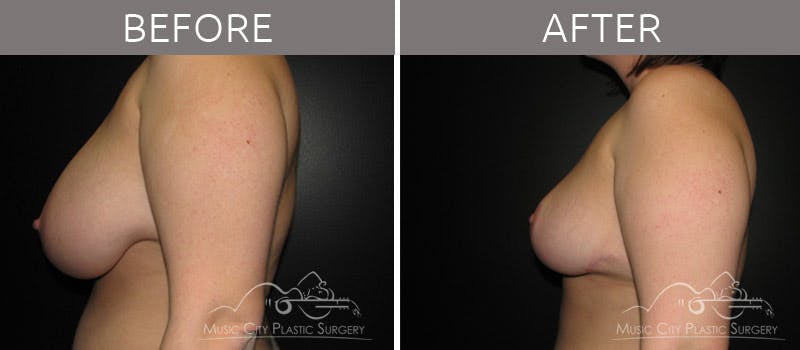 Breast Reduction with Lift Before & After Gallery - Patient 132099796 - Image 1