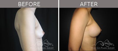 Breast Augmentation Before & After Gallery - Patient 90705054 - Image 3