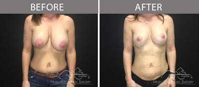 Capsulectomy Before & After Gallery - Patient 90705062 - Image 1