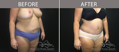 Abdominoplasty Before & After Gallery - Patient 90705063 - Image 2