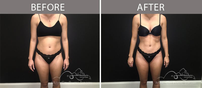 Liposuction Before & After Gallery - Patient 90705061 - Image 1
