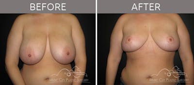 Breast Reduction with Lift Before & After Gallery - Patient 132099796 - Image 1